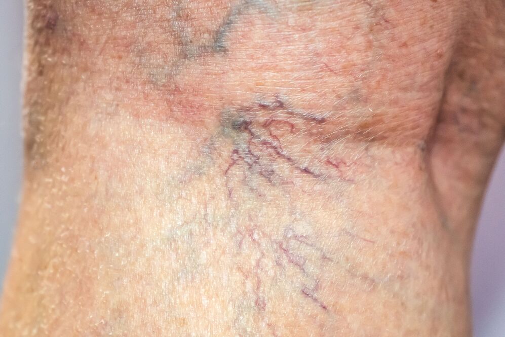 Varicosis veins in the body