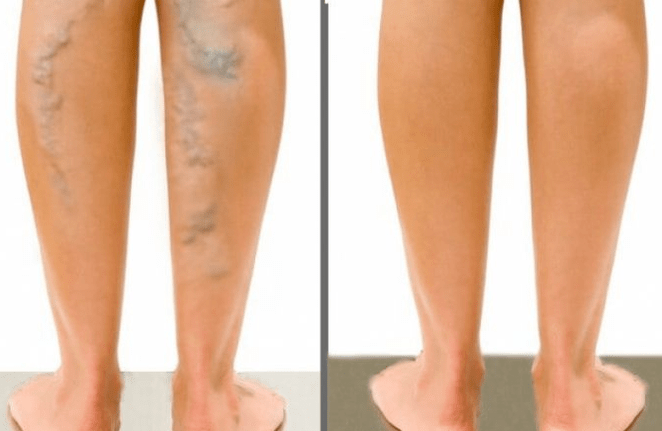 Varicosis veins before and after surgery