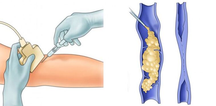 The treatment of varicose veins