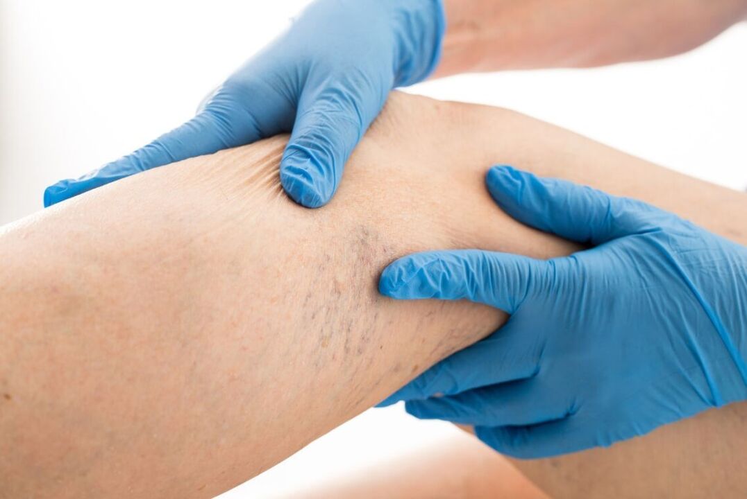 Varicosis of the Clinical Card