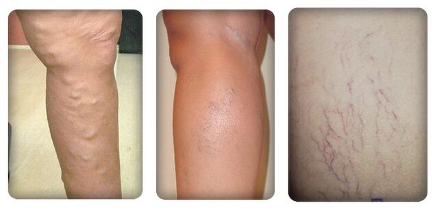 Stages of varicose veins