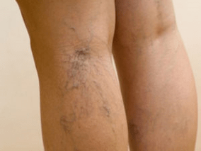 The second stage of varicose veins