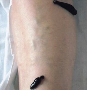Hirudotherapy as a method of treatment of varicose veins