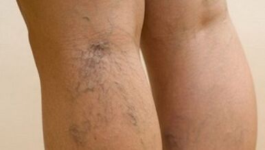 Reasons for varicose veins