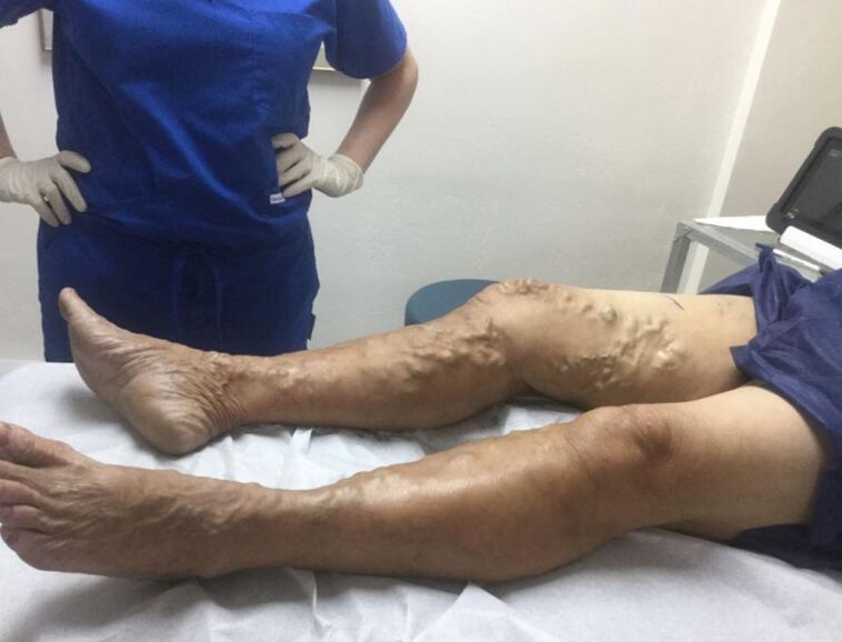 Results of treatment of varicose veins