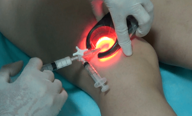 Sclerotherapy is an effective method of treating varicose veins in the legs