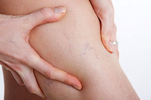 The first appearance of varicose veins in the leg