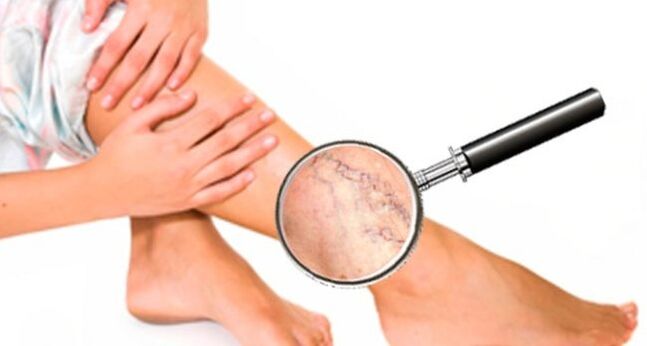 Varicose veins in the legs