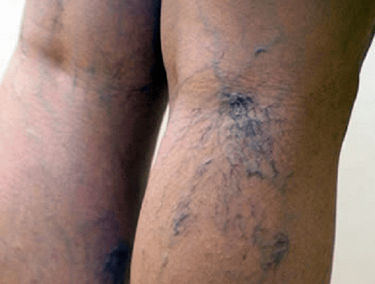 varicose veins in the legs